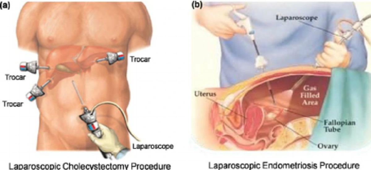 ส่องนวัตกรรมการแพทย์ : เทคโนโลยีการผ่าตัดส่องกล้องปอดขั้นสูง