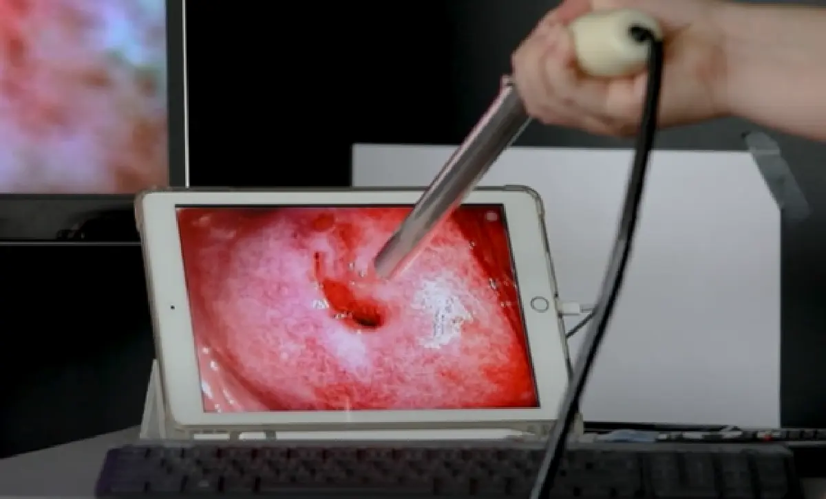 นวัตกรรมเอไอ ช่วยตรวจมะเร็งปากมดลูกรู้ผลไวใน 1 วินาที