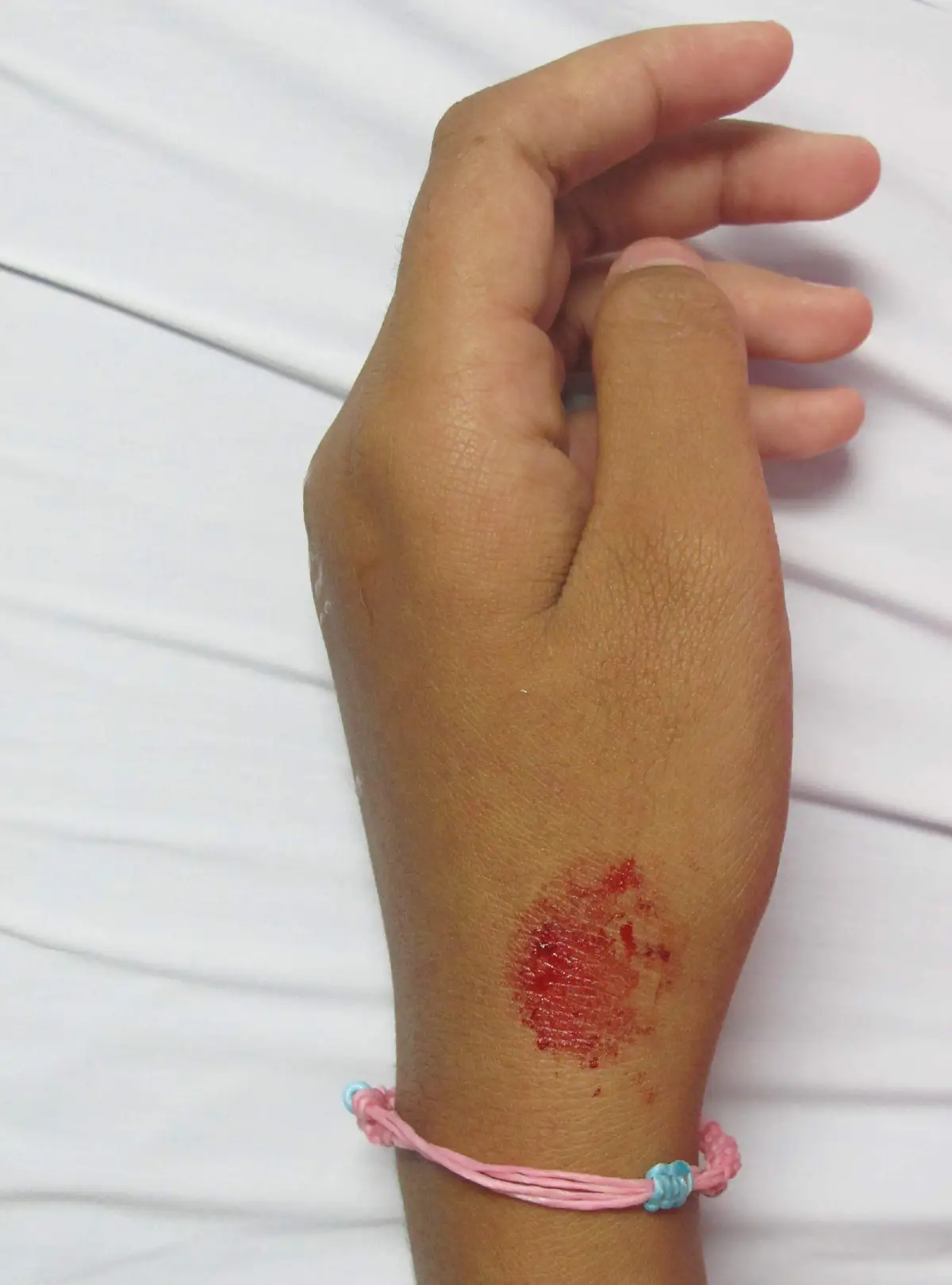 เหงื่อออกเป็นเลือด โรคที่พบน้อย รักษาให้หายขาดได้ 