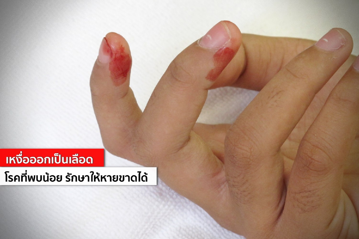 เหงื่อออกเป็นเลือด โรคที่พบน้อย รักษาให้หายขาดได้ เหงื่อออกเป็นเลือด โรคที่พบน้อย รักษาให้หายขาดได้