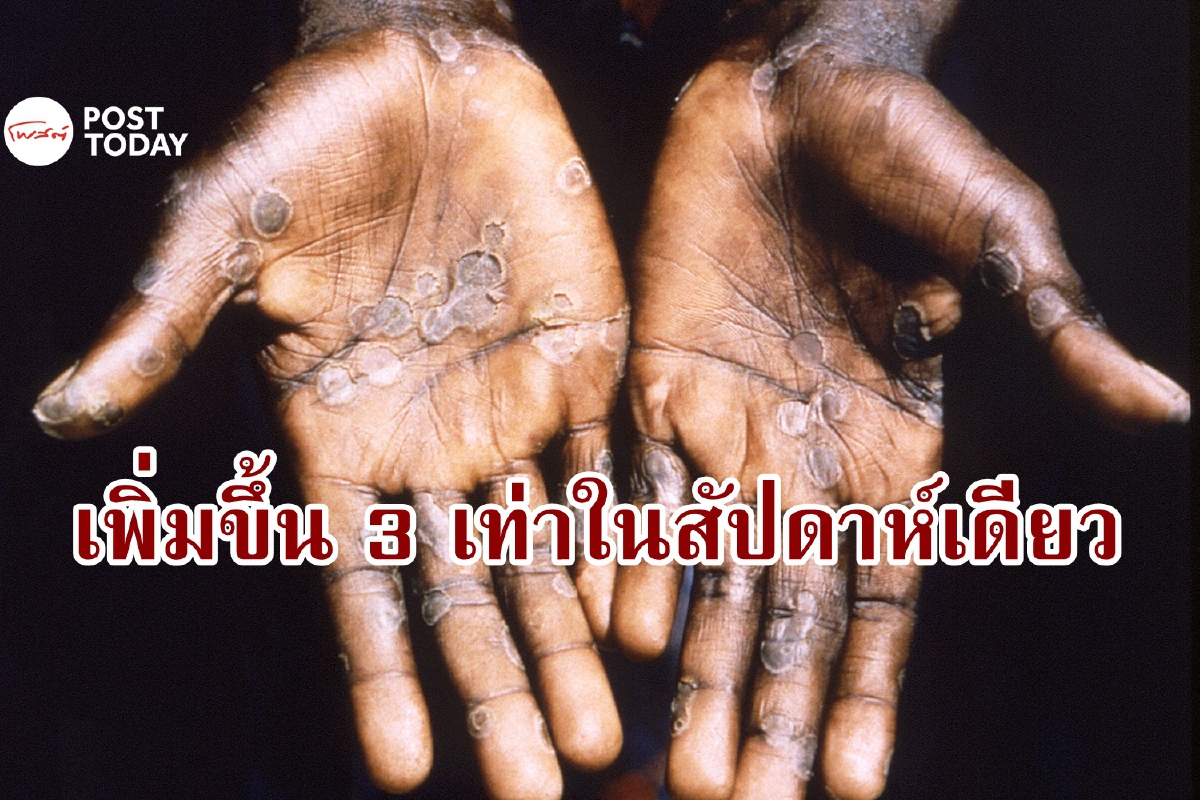 ยอดพุ่งต่อเนื่อง ผู้ป่วยฝีดาษลิงเพิ่มขึ้น 3 เท่าใน 1 สัปดาห์