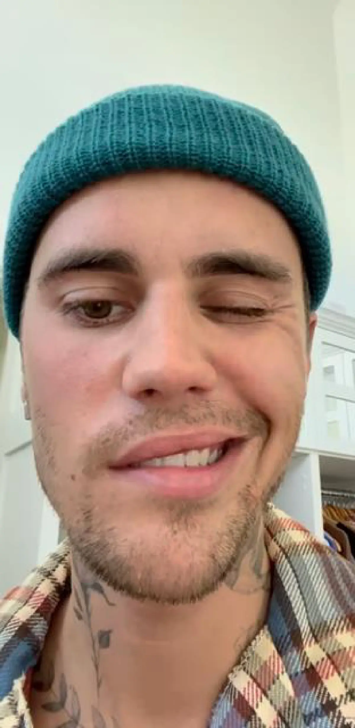  “จัสติน บีเบอร์” ใบหน้าอัมพาตครึ่งซีก! ต้องเลื่อนทัวร์คอนเสิร์ตเพื่อรักษาตัว