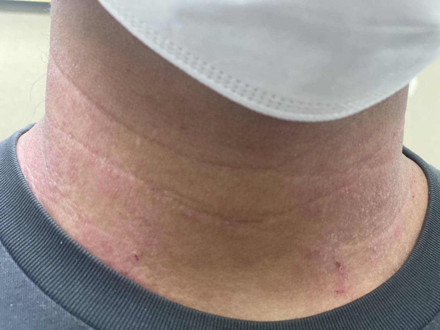 ผื่นภูมิแพ้ผิวหนัง รักษาเร็วหยุดความเสี่ยงภูมิแพ้ชนิดอื่น