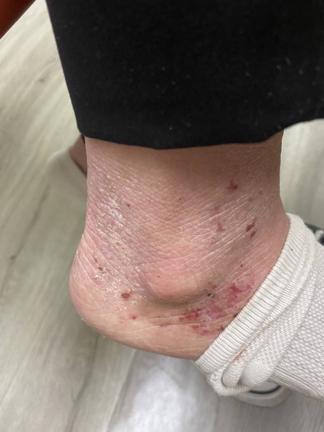 ผื่นภูมิแพ้ผิวหนัง รักษาเร็วหยุดความเสี่ยงภูมิแพ้ชนิดอื่น