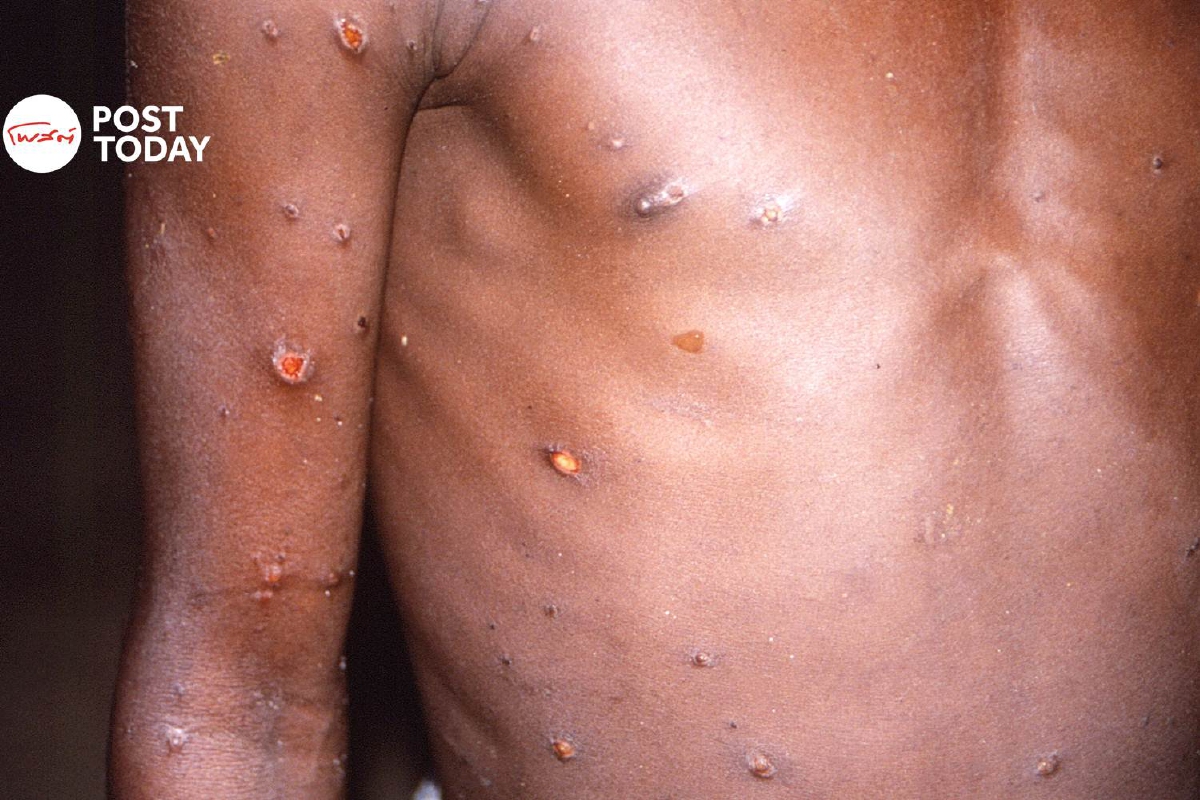 นักวิทย์ชี้โรคฝีดาษลิงกลายพันธุ์มากกว่าที่คาดไว้