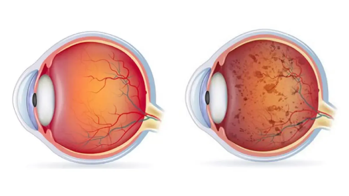 Next to know - เมื่อยาพิษสุราเรื้องรัง สามารถใช้รักษาจอประสาทตาเสื่อมได้