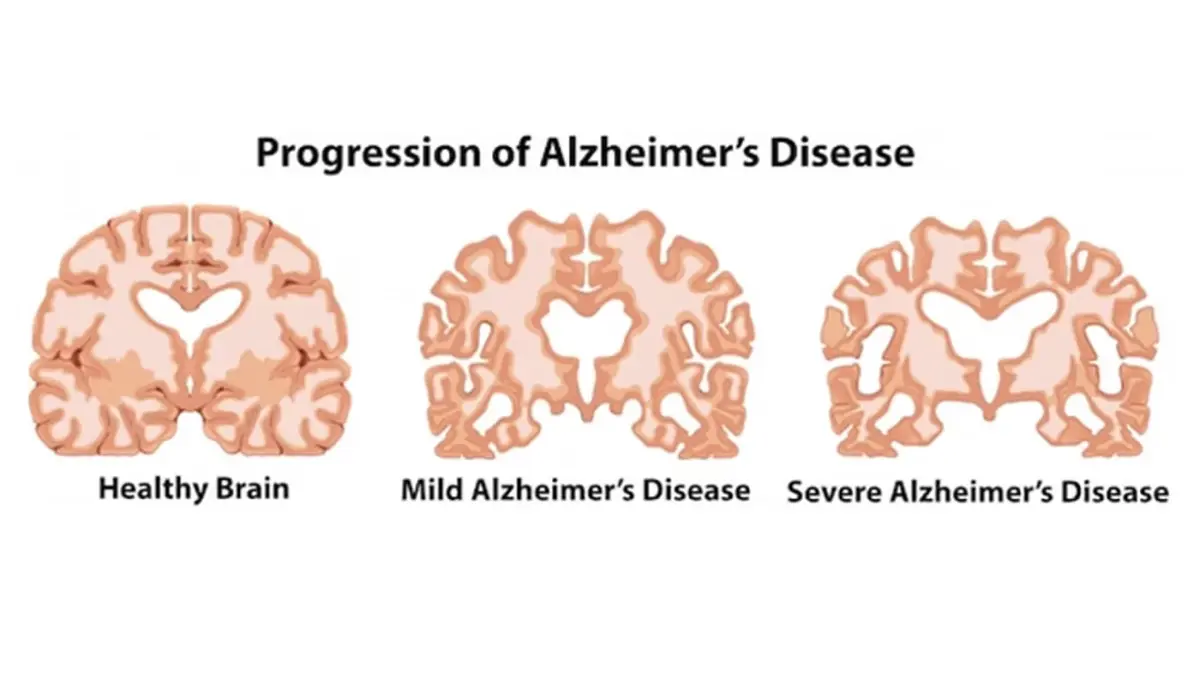 Next to know อัลไซเมอร์สามารถวินิจฉัยได้ด้วยเลือด