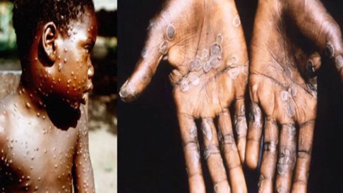 ฝีดาษลิงคืออะไร? น่ากลัวแค่ไหน? มีวิธีรับมืออย่างไร?