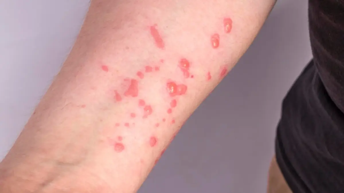 ข้อมูลเกี่ยวกับวัคซีนฝีดาษลิงในปัจจุบัน โลกพร้อมรับมือแค่ไหน