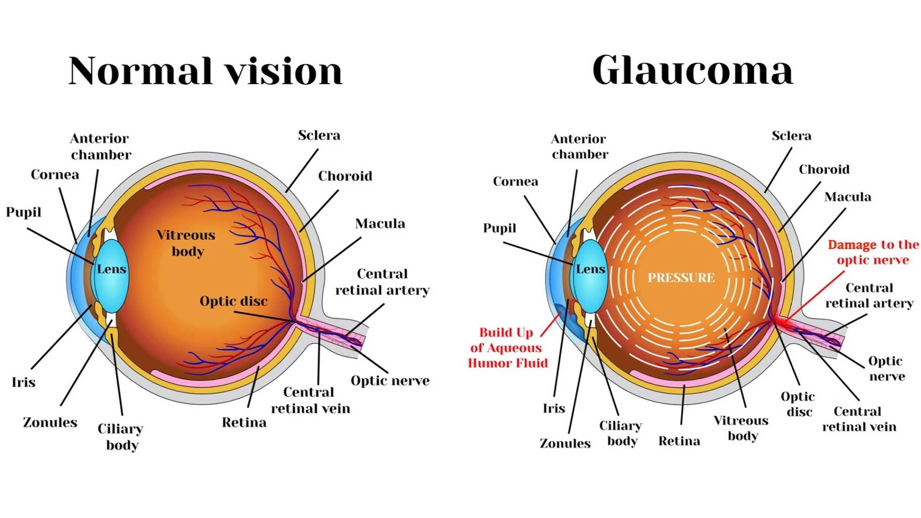 คอนแทคเลนส์อัจฉริยะช่วยป้องกันการตาบอดจากเบาหวานและต้อหิน