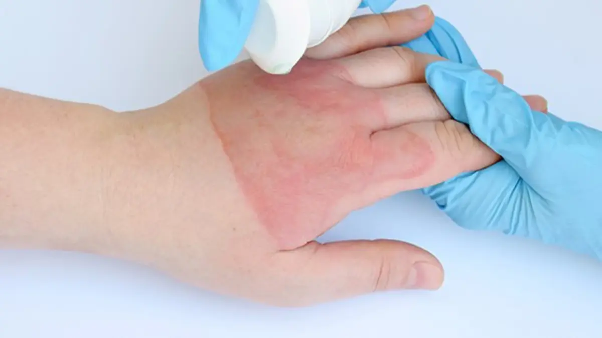 ผ้าพันแผลชนิดใหม่ที่ถูกใช้ในการรักษาแผลไฟไหม้