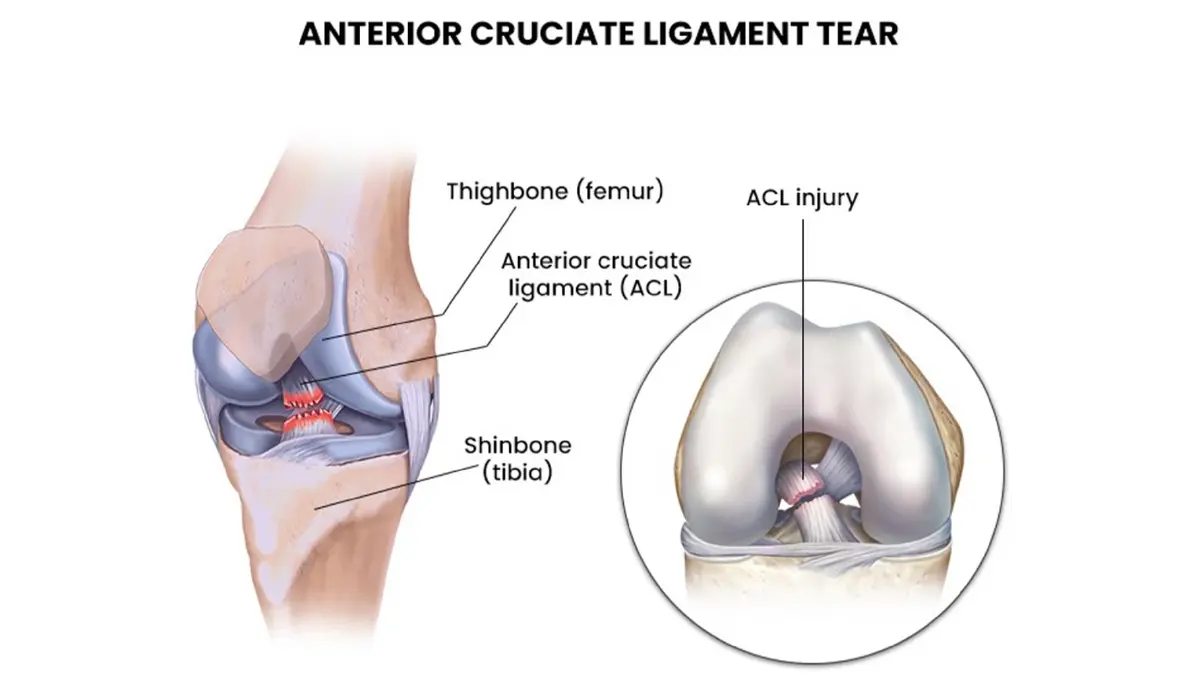 การรักษาเส้นเอ็นไขว้หน้าข้อเข่าฉีกขาดแบบใหม่ไม่ต้องผ่าตัด