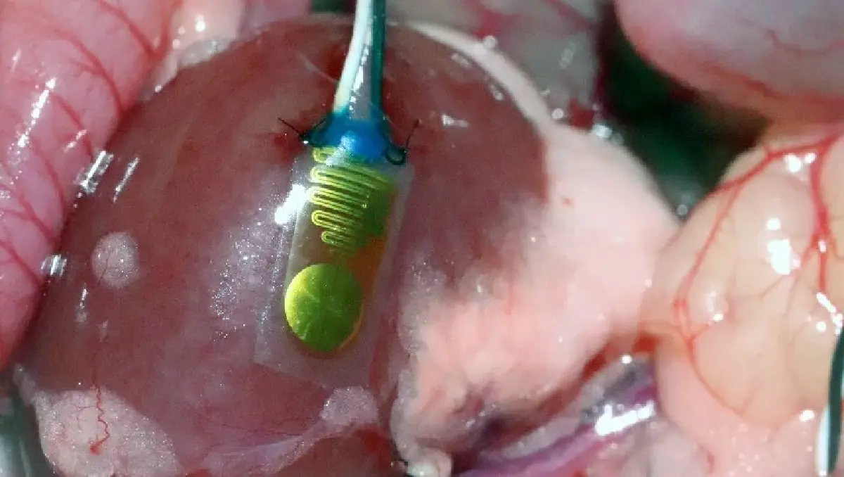 เซ็นเซอร์ชนิดใหม่สามารถตรวจสอบอวัยวะปลูกถ่ายแบบเรียลไทม์