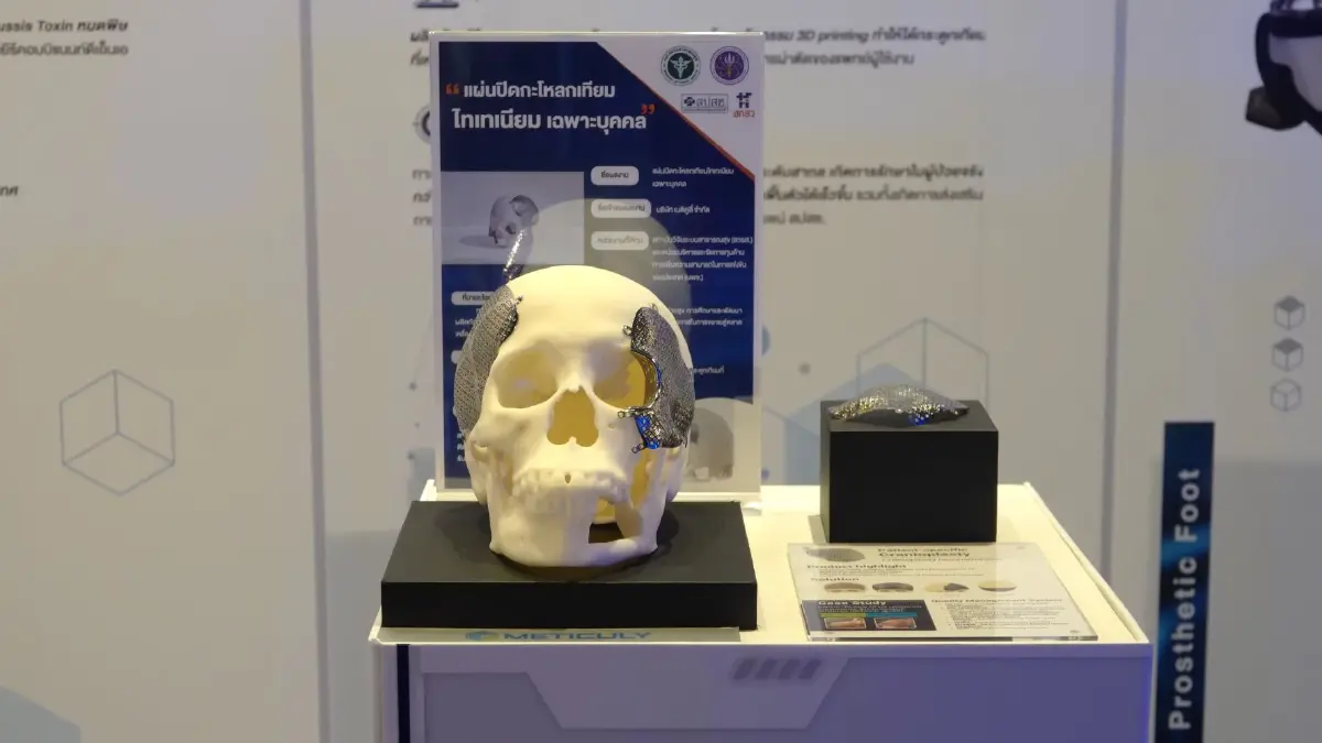 แผ่นปิดกะโหลกไทเทเนียมเฉพาะบุคคล