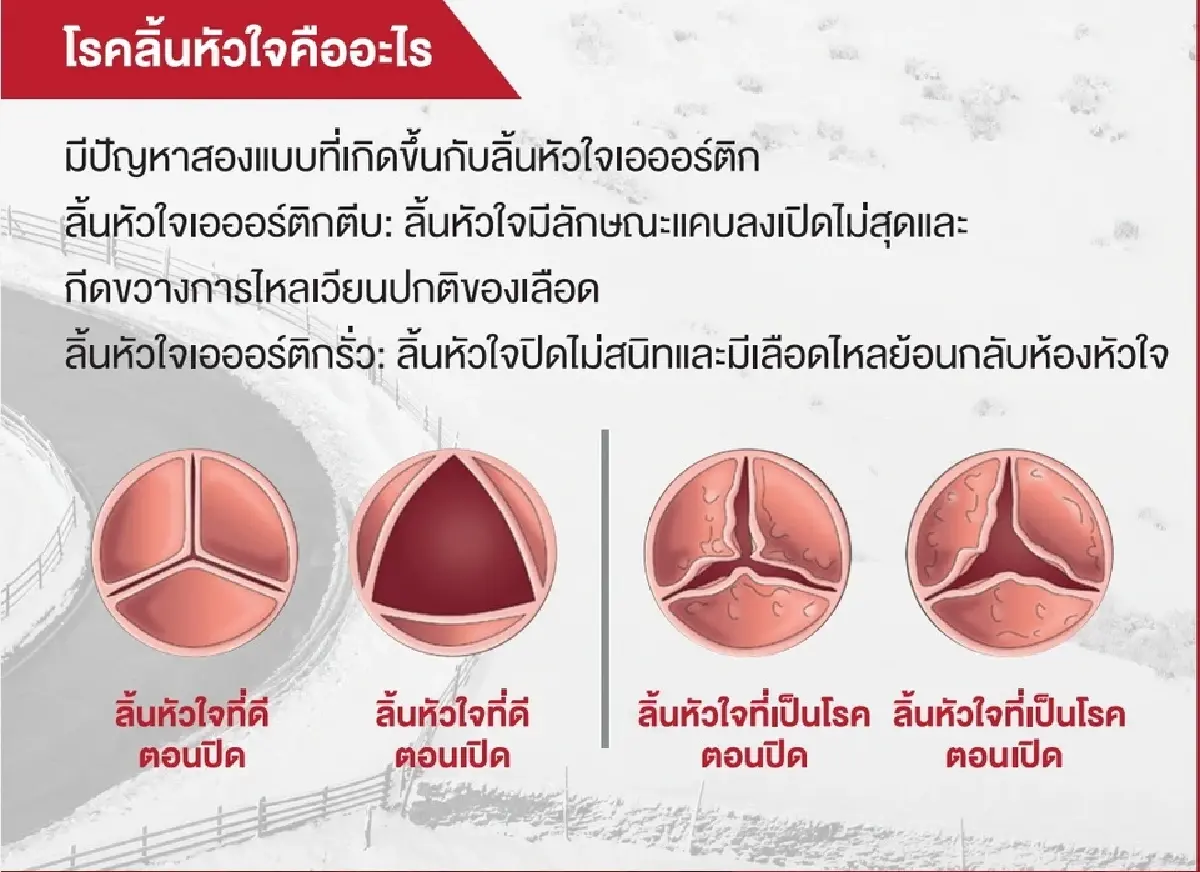 รู้สัญญาณอันตราย 'โรคลิ้นหัวใจ' สูงวัยเสี่ยงป่วยถึงแก่ชีวิต