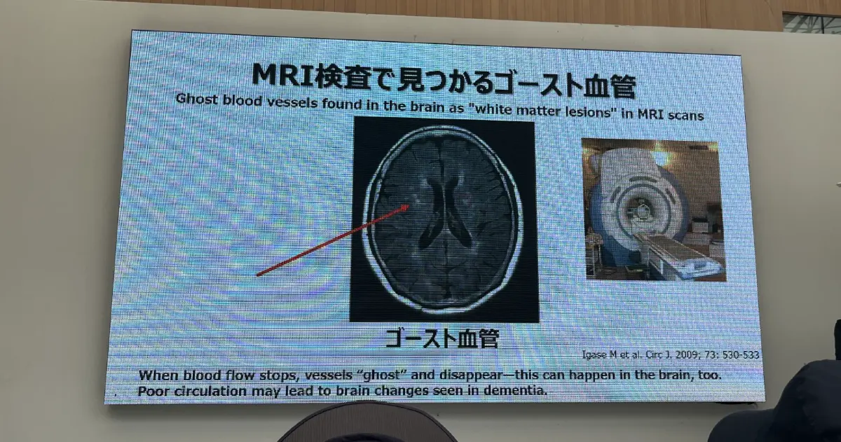 MRI ของสมองมนุษย์รายหนึ่งชี้ให้เห็น 'หลอดเลือดโกสต์'