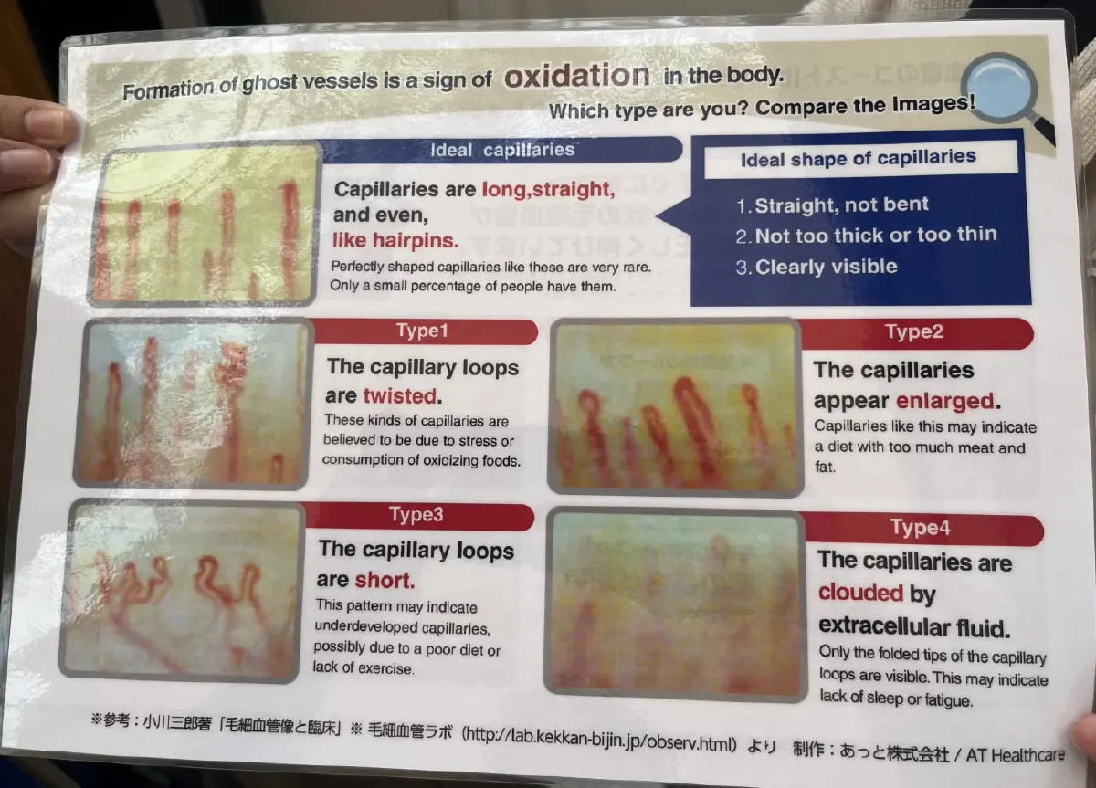 การตรวจเส้นเลือดฝอยที่บริเวณโคนเล็บแสดงผลของเส้นเสือดฝอยแตกต่างกัน