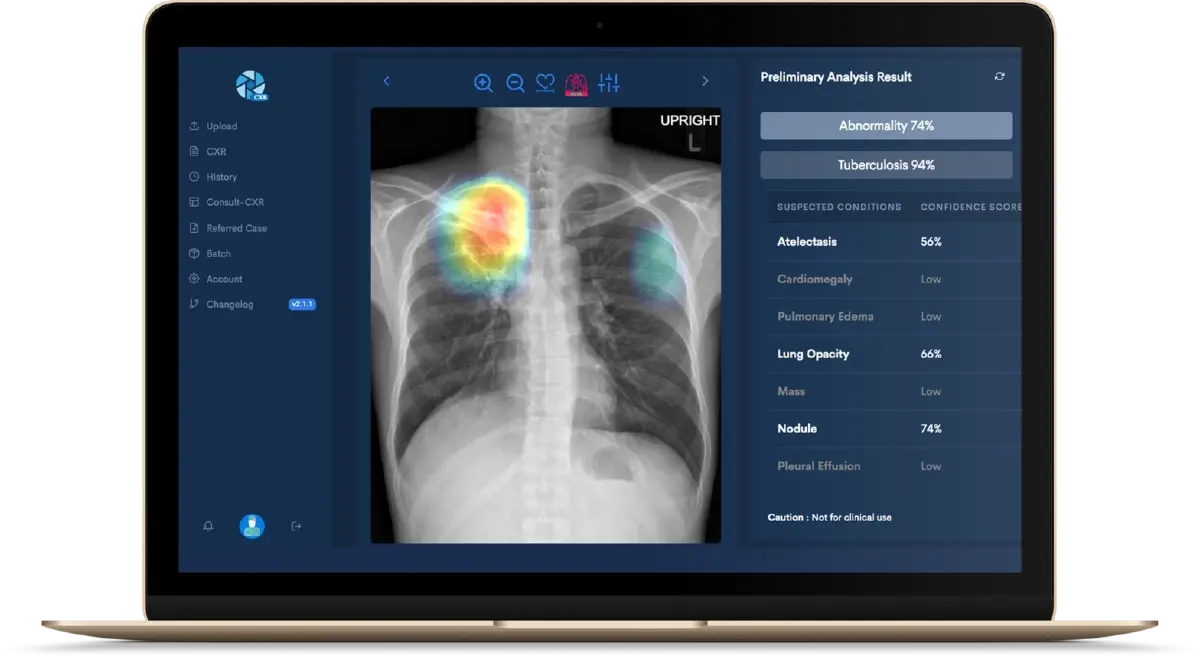 AI Chest X-ray ของบริษัท Perceptra นวัตกรรม AI ทางการแพทย์สัญชาติไทย