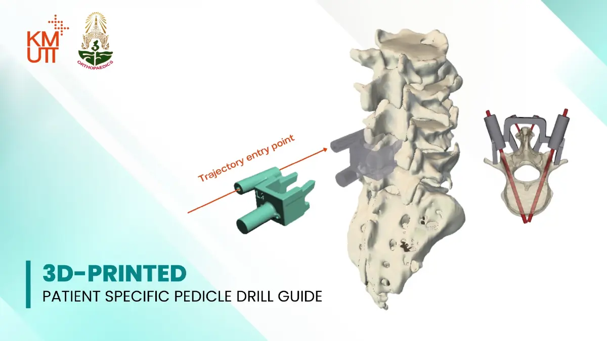 ไทยทำได้! มจธ.จับมือ 3 โรงพยาบาล ดัน AI-3D Printing ผลิตอุปกรณ์แพทย์เฉพาะบุคคล