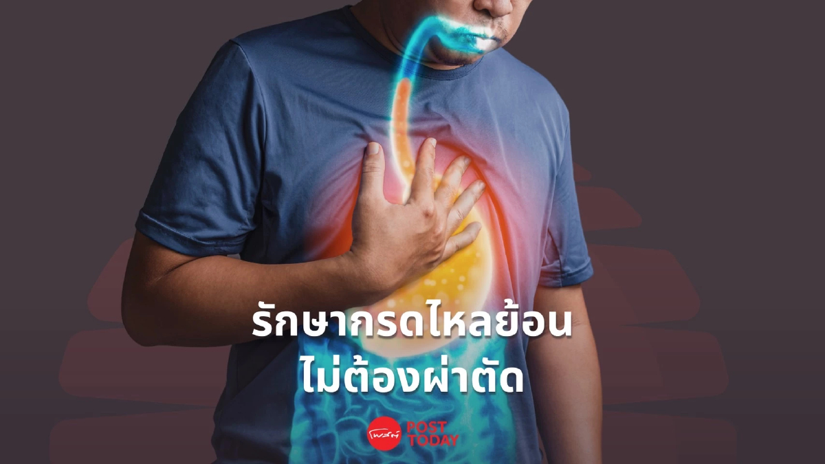 รพ.บำรุงราษฎร์ ล้ำ รักษาโรคกรดไหลย้อนโดยไม่ต้องผ่าตัด รพ.บำรุงราษฎร์ ล้ำ รักษาโรคกรดไหลย้อนโดยไม่ต้องผ่าตัด