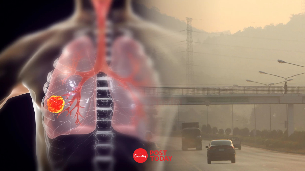 กรมการแพทย์แจง ฝุ่น PM 2.5 ไม่ใช่สาเหตุเดียวของโรคมะเร็งปอดภาคเหนือ กรมการแพทย์แจง ฝุ่น PM 2.5 ไม่ใช่สาเหตุเดียวของโรคมะเร็งปอดภาคเหนือ