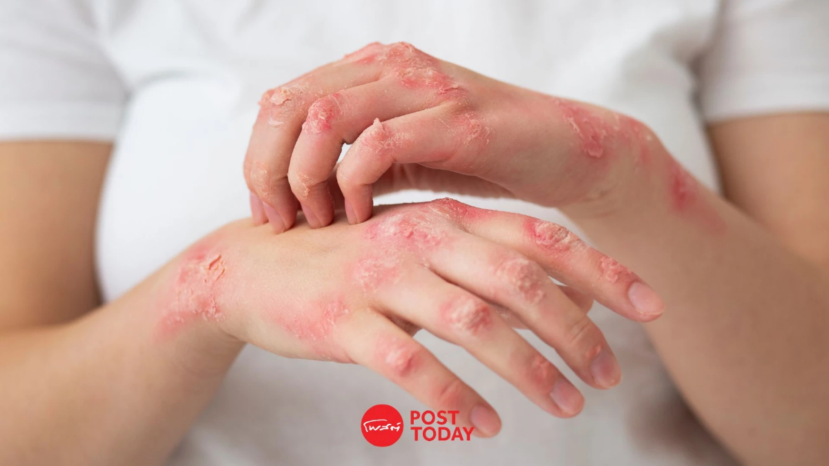 รัฐบาลเผยยอดป่วย "ฝีดาษวานร" สะสม 1,000 ราย กทม.ครองแชมป์ รัฐบาลเผยยอดป่วย "ฝีดาษวานร" สะสม 1,000 ราย กทม.ครองแชมป์