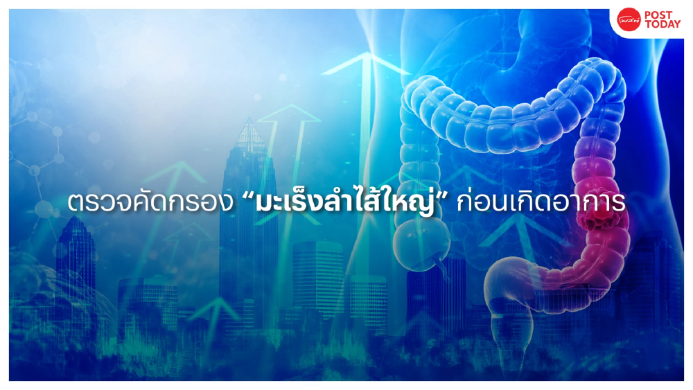 โลกเดินหน้า! หาวิธีคัดกรอง "มะเร็งลำไส้ใหญ่" ก่อนแสดงอาการ