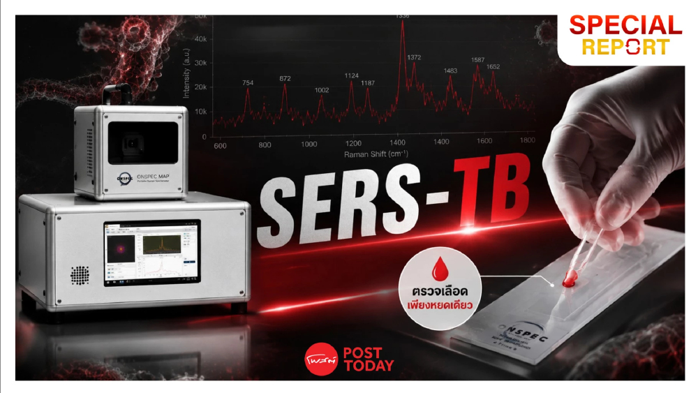 “SERS-TB” นวัตกรรมไทย พลิกเกมรุก “วัณโรคแฝง”